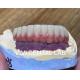 Composite Veneered Tooth Supported Bridge Implant Ivoclar Customized
