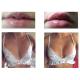 Breast Enlargement Injection Filler Hyaluronic Acid Implant Lip Injections Dermal Filler