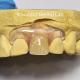 Dental TCS Valplast Flexible Partial Dentures Staining Fading Odors Resistant