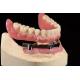 Titanium Implant Supported Dentures Precise Ivoclar Denture Over Implants