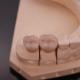 Comfortable Zirconia Crown with Precise Esthetic Finish Express 3-4 Day Turnaround Time