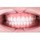 High Translucency Dental Laminate Veneers Long Lasting Durability Polishing