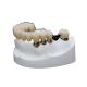 Corrosion Resistance Dental Telescopic Crown Precision Attachment Denture Strong Stability