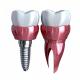 Bridging The Gap Our Role In Enhancing Oral Health With Dental Implant Crowns