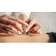 0.16mm Silver Intradermal Acupuncture Needles For Pain Relief