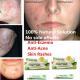 natural anti-bacteria gel anti acne anti eczema herbal gel