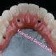 Dental Implant Crown PFZ Porcelain Layered Zirconia Screw Retained With Pink Gum