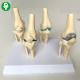 Knee Joint Model  Health And Pathology Comparative 23X20X12 Cm Package