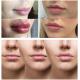 Smooth Lines / Plump Lips With Hyaluronic Acid Injectable Filler 1ml 2ml 5ml