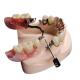 Mk1 Precision Attachment Denture Beautiful Natural Corrosion Resistant