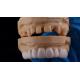 High Esthetics Dental Snap On Smile Standard Dental Lab Removable Dental Appliance