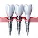 Prioritizing Patient Satisfaction Our Commitment To Quality Dental Implant Crowns
