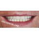 ISO Full Mouth Dental Bridge Multi Layer Zirconia Teeth Bridge