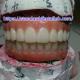 Dental Implant Temporary Crown PMMA Bridge With Pink Porcelian