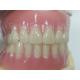 Comfort Custom Fit Full Acrylic Denture For Precise Dental Prosthesis