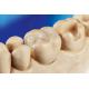 Porcelain Dental Inlay Onlay Zirconia Emax High Esthetics FDA Approved