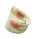 Steel Removable Partial Dentures Denture Restoration Dental Lab Products