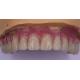 Patient Comfort Custom Dental Crowns Polished Titanium/Zirconia/PFM Implant Crown