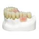 MK1 Precision Attachment Denture for Perfect Fit and Protection