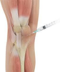 Steroid injection in knee osteoarthritis