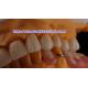 Layered Dental Zirconia Crown And Bridge Translucency 3D PRO zirconia porcelain crown Standard Dental Lab