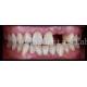 Customised Natural Temporary Dental Veneers For A Beautiful Smile