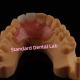 Dental Valplast Flexible Flipper Dentures Removable Partial Denture