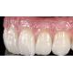 Esthetic Dental Lab Crowns Professional Anterior Tooth Crown