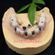 Screw Retained Dental Implant Metal Ceramic Crowns Malo Bridge