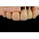 Titanium Sandblasted Single Tooth Replacement Implant With Gamma Irradiation Sterilization