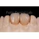 High Translucency Multi Layer Zirconia For Fabrication Of Dental Restorations