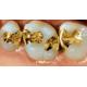 Gentle Dental Inlay Onlay Crowns 74% Gold Inlays And Onlays