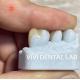 Professional Emax Dental Inlay Onlay High Accuracy Digital Processing