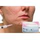1ml Sodium Hyaluronate Gel Injection For Removing Fine Facial Wrinkles