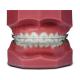 Comfortable Fixed Orthodontic Appliances Beautiful Natural Ceramic Brackets