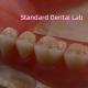 SDL Heat Cured Acrylic Partial Denture Ivoclar Teeth Dental Lab High Accuracy