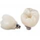 Screw Retained Dental Implant Crown PFZ Porcelain Layered Zirconia