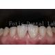 Polishing Synthetic Dental Laminate Veneers High Stain Resistance