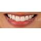 High End Cosmetic Teeth Veneers For Perfect Smile Stain Resistance