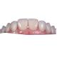 0.3MM Whitening Ceramic Dental Crown To Replace Unhealthy Teeth