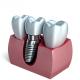 The Journey To A Healthy Smile Our Dental Implant Crown Process