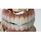 Dental All On X Implant PFM Crown Titanium Fixed Hybrid Denture