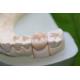 Aesthethics Glass Ceramic EMAX Posterior Crowns For Molars