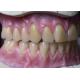 Hot Cured Full Arch Removable Acrylic Full Denture