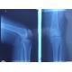 Blue X Ray Diagnostic Imaging , Medical Laser Paper Xray Photographic Film