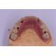 Dental Implant Titanium Tooth Crown Precision Fit Custom Design
