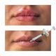 Non Surgical Lip Enhancement Fillers Hyaluronic Acid Lip Injections