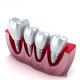 Revolutionizing Dental Restorations Our Dental Implant Crowns