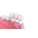 High Strength Dental Crown Bridge Realistic Appearance Good Stability Bite Force