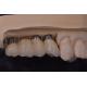 Precision Fit Dental Implant Crowns Titanium / Zirconia / PFM Restoring Missing Teeth